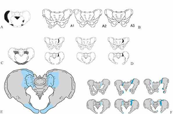 FRACTURES AND DISLOCATIONS OF THE PELVIC RING - TeachMe Orthopedics