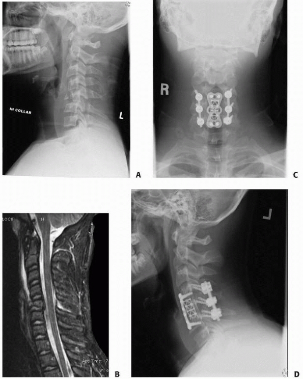 Cervical Spine Injuries in Children - TeachMe Orthopedics