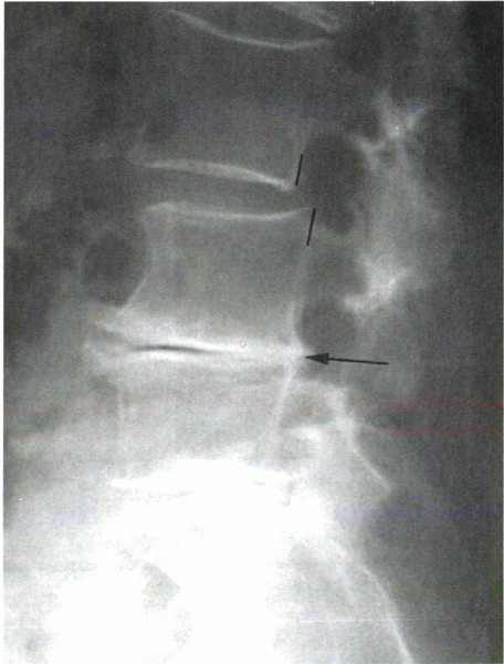 Lumbar Spondylo-Listhesis - TeachMe Orthopedics