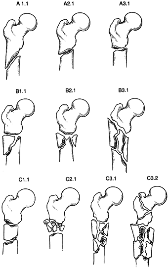 FRACTURES OF THE HIP AND PROXIMAL FEMUR - TeachMe Orthopedics