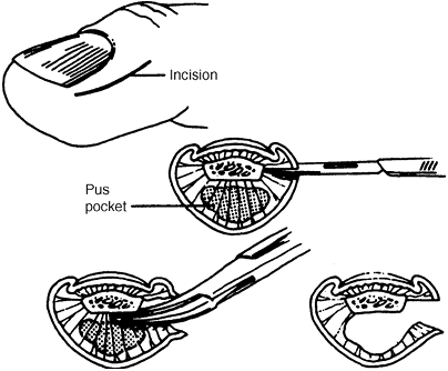 Acute Wrist and Hand Injuries - TeachMe Orthopedics