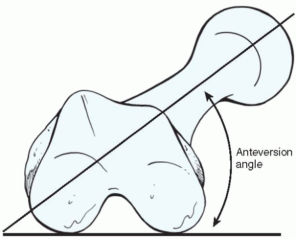 Rotational Deformities Of The Lower Extremities Teachme Orthopedics 5679