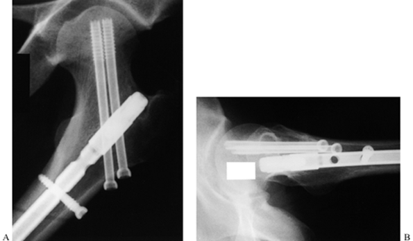 DIAPHYSEAL FRACTURES OF THE FEMUR - TeachMe Orthopedics