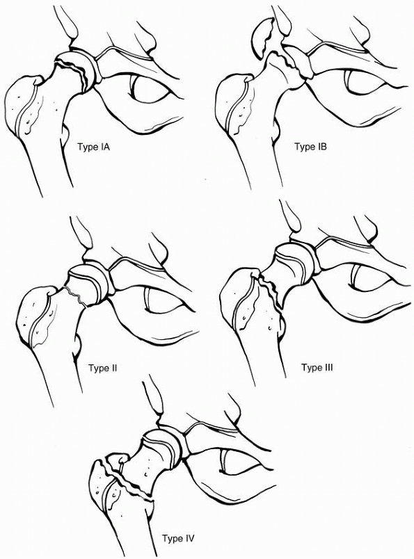 Fractures and Traumatic Dislocations of the Hip in Children - TeachMe ...