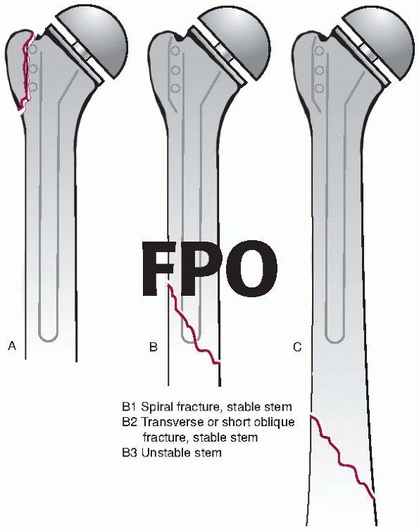 Periprosthetic Fractures - TeachMe Orthopedics