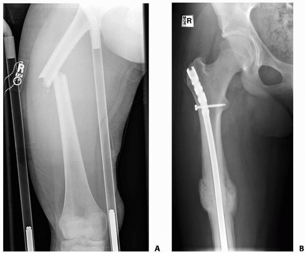 Femoral Shaft Fractures Teachme Orthopedics