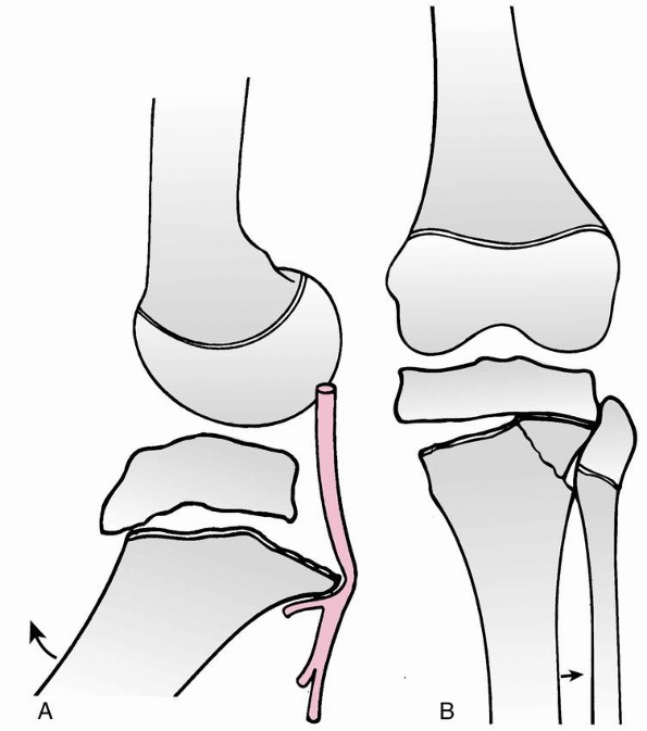 Extra-Articular Injuries of the Knee - TeachMe Orthopedics