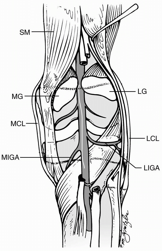 Extra-articular Injuries Of The Knee - Teachme Orthopedics