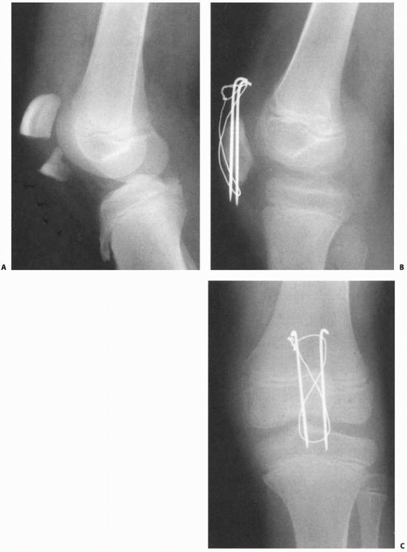 Extra-Articular Injuries Of The Knee - TeachMe Orthopedics