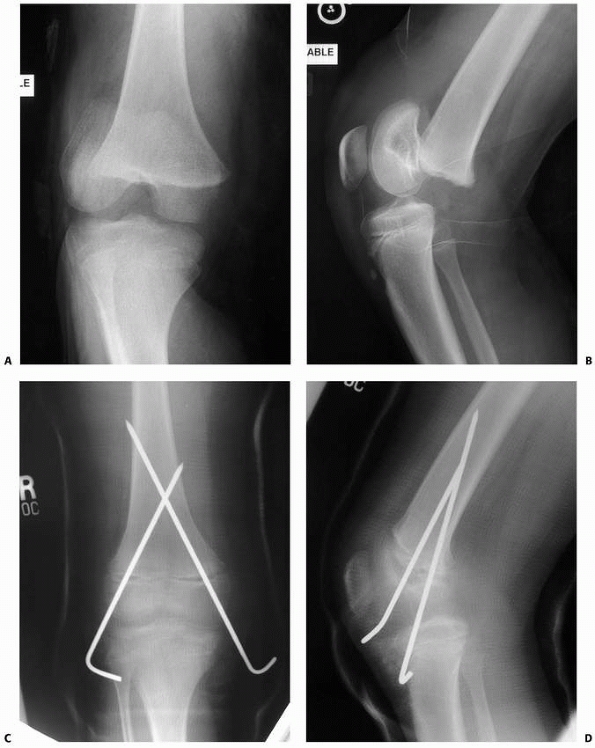 Эпифизеолиз это. Extension fixation of Fracture.