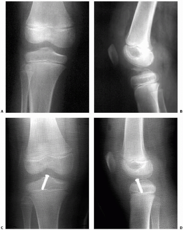 Intra-Articular Injuries Of The Knee - TeachMe Orthopedics