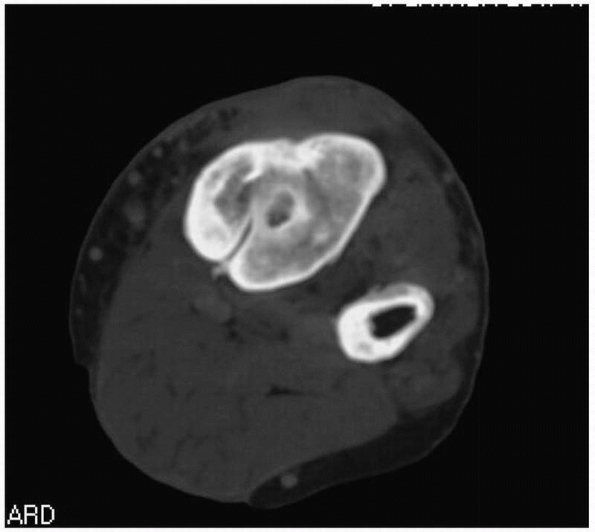 Orthopaedic Infections And Osteomyelitis - TeachMe Orthopedics