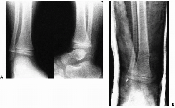 torus fracture of left fibula