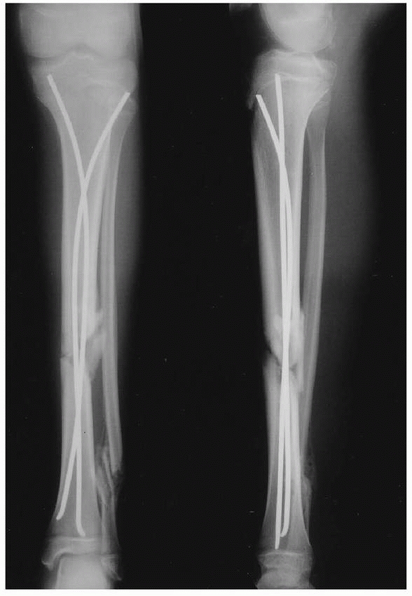 Fractures of the Shaft of the Tibia and Fibula - TeachMe Orthopedics