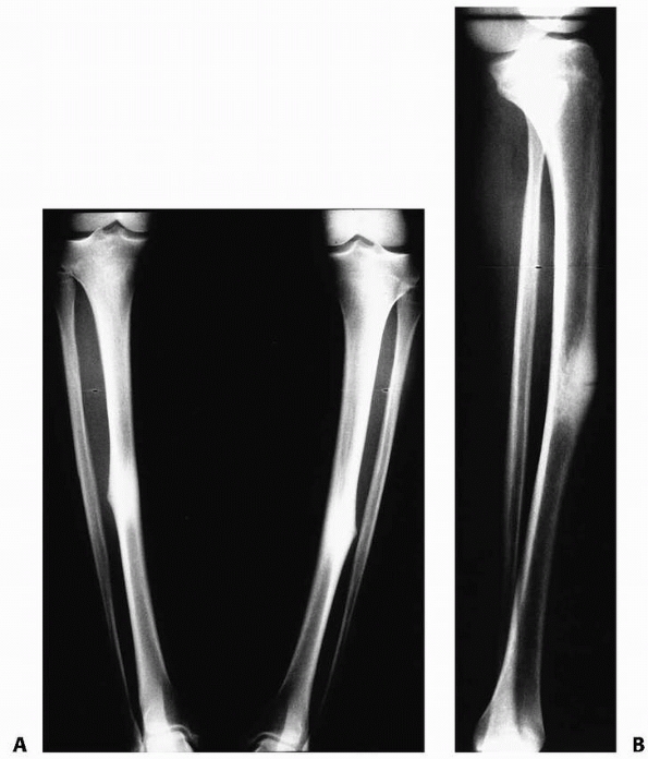 Fractures of the Shaft of the Tibia and Fibula - TeachMe Orthopedics