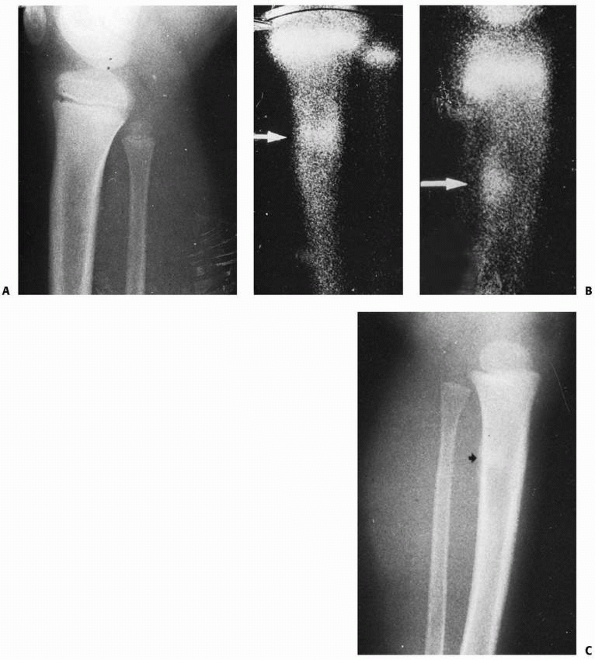 Fractures of the Shaft of the Tibia and Fibula - TeachMe Orthopedics