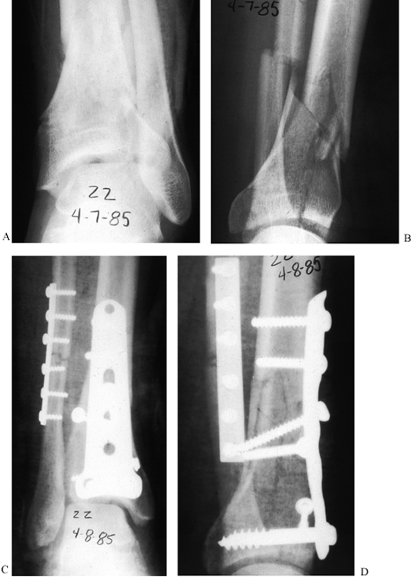 ANKLE FRACTURES AND DISLOCATIONS INCLUDING PYLON FRACTURES - TeachMe ...