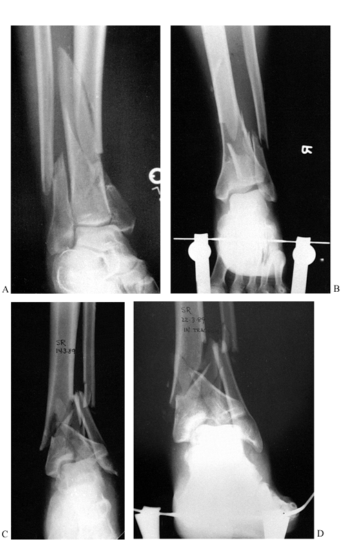 ANKLE FRACTURES AND DISLOCATIONS INCLUDING PYLON FRACTURES - TeachMe ...