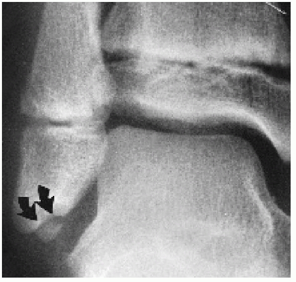 ser 4 right lateral malleolus fracture