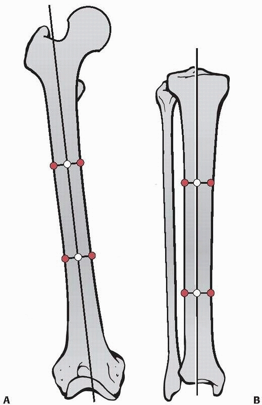 Principles of Malunions - TeachMe Orthopedics