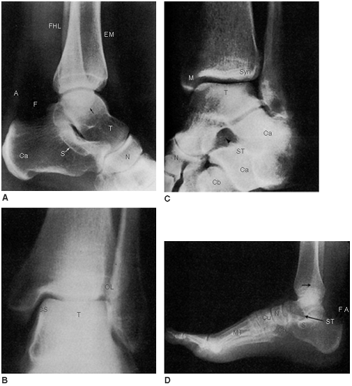 Ankle Injuries - TeachMe Orthopedics