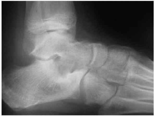 Fractures and Dislocations of the Foot - TeachMe Orthopedics