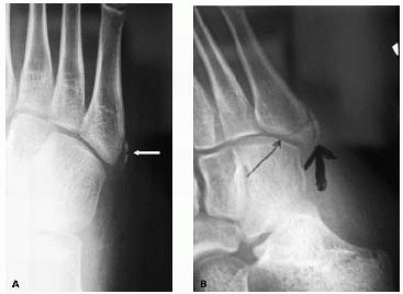 Fractures and Dislocations of the Foot - TeachMe Orthopedics