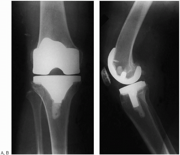 Total Knee Arthroplasty - TeachMe Orthopedics