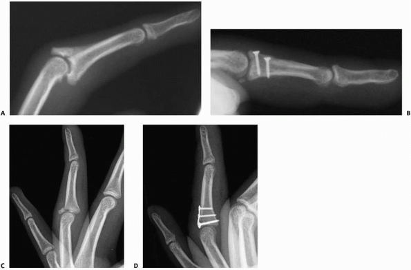 Hand Fractures and Dislocations - TeachMe Orthopedics
