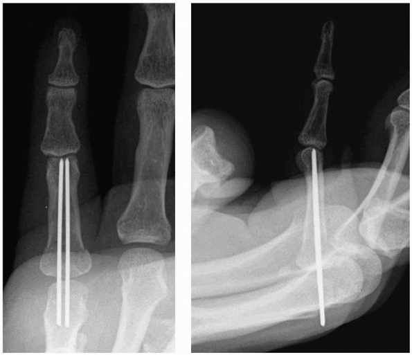 Hand Fractures and Dislocations - TeachMe Orthopedics