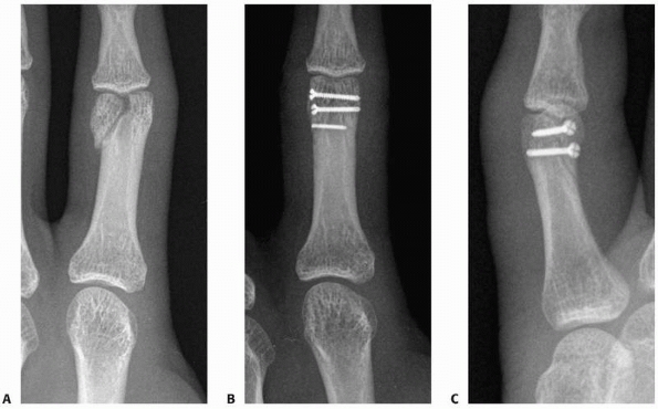 Hand Fractures and Dislocations - TeachMe Orthopedics