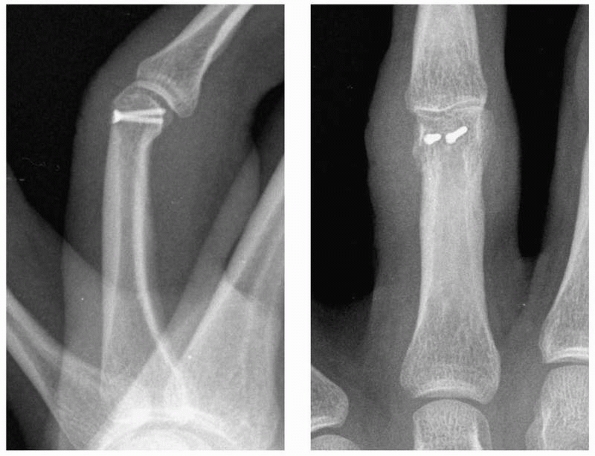 Hand Fractures and Dislocations - TeachMe Orthopedics