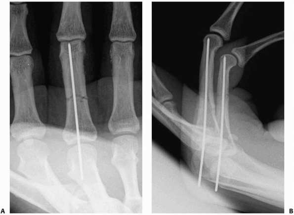 Hand Fractures and Dislocations - TeachMe Orthopedics