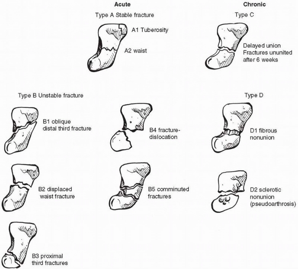 Carpus Fractures and Dislocations - TeachMe Orthopedics