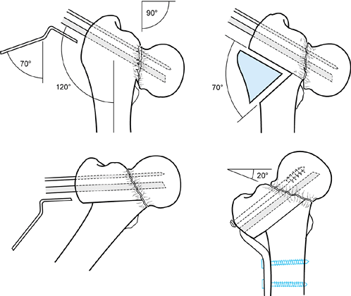 NONUNIONS AND MALUNIONS OF THE HIP - TeachMe Orthopedics