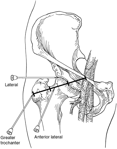 Aspiration and Injection of Upper and Lower Extremities - TeachMe ...