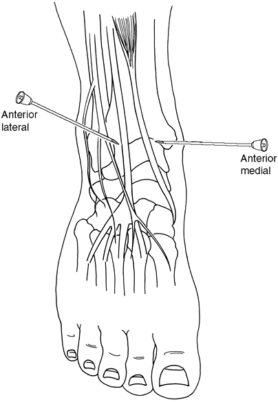 Aspiration and Injection of Upper and Lower Extremities - TeachMe ...