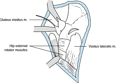 SURGICAL APPROACHES TO THE ACETABULUM AND PELVIS - TeachMe Orthopedics