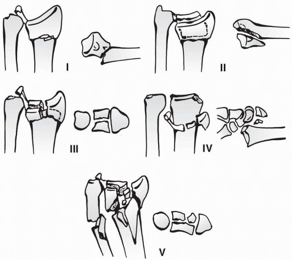 Distal Radius and Ulna Fractures - TeachMe Orthopedics