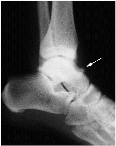 Arthroscopy of the Ankle - TeachMe Orthopedics