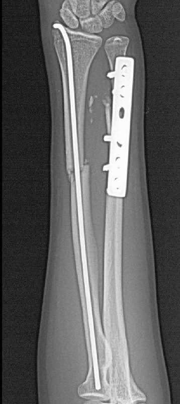 Radial And Ulnar Shaft Fractures - TeachMe Orthopedics