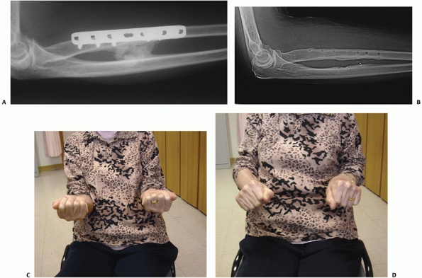 Radial And Ulnar Shaft Fractures - TeachMe Orthopedics