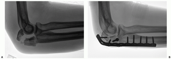 olecranon fracture orthobullets