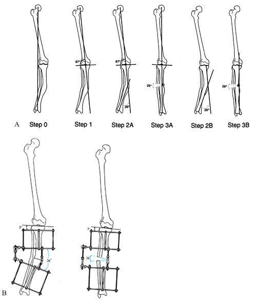 MANAGEMENT OF FRACTURES, NONUNIONS, AND MALUNIONS WITH ILIZAROV ...