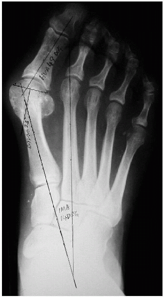 Hallux Valgus Correction: Modified Mcbride and Chevron Osteotomy ...