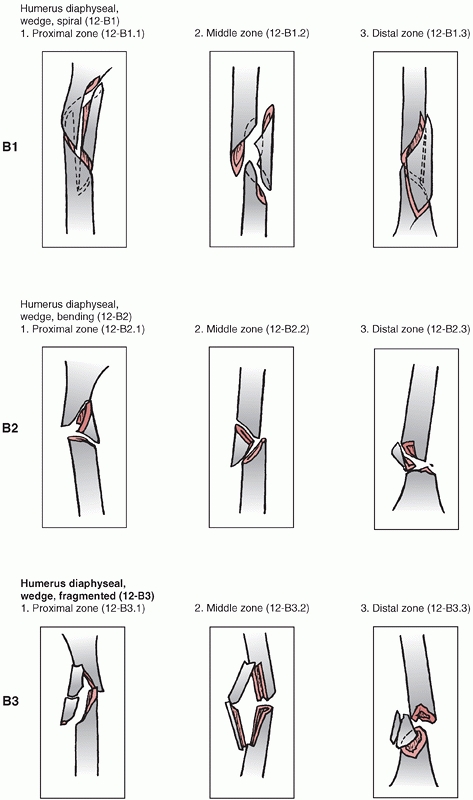 Humeral Shaft Fractures - TeachMe Orthopedics