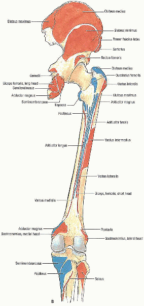 Intramedullary Femoral Nailing - TeachMe Orthopedics