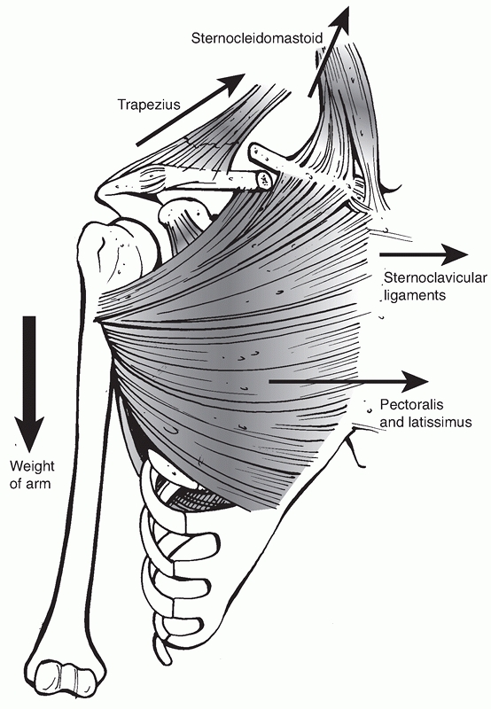 Clavicle Fractures - TeachMe Orthopedics