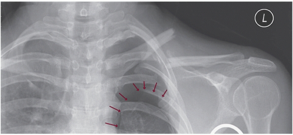 Clavicle Fractures - Teachme Orthopedics