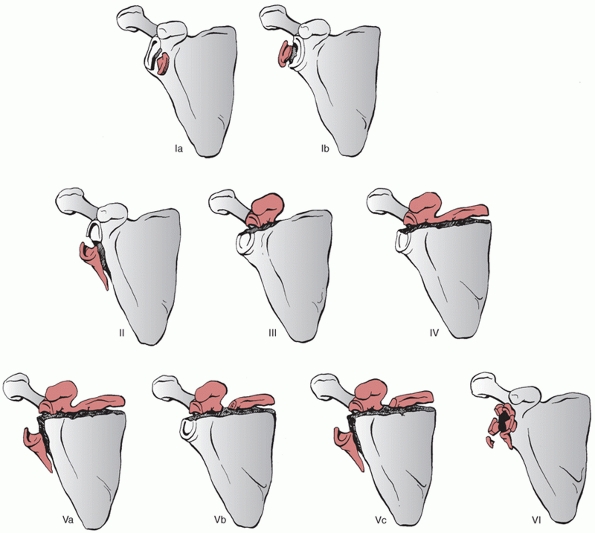 Scapular Fractures TeachMe Orthopedics